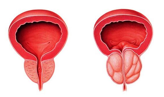 Normal an entzündegt Prostata (Prostatitis)
